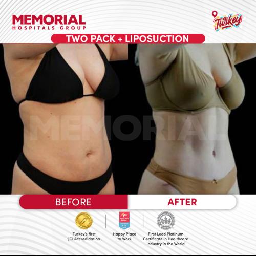 Abdominal Etching Photo avant/après